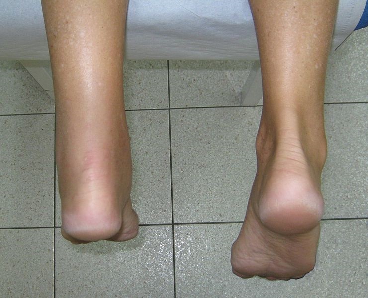 PRP for Achilles tendonitis