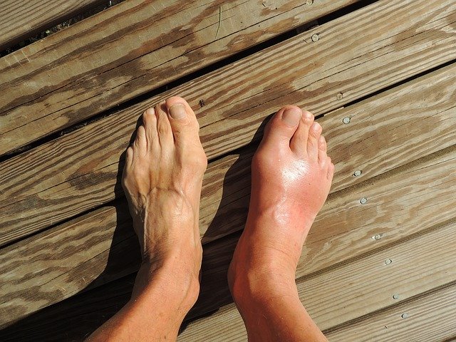 stem cell therapy ankle arthritis