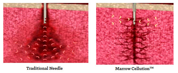 marrow cellution